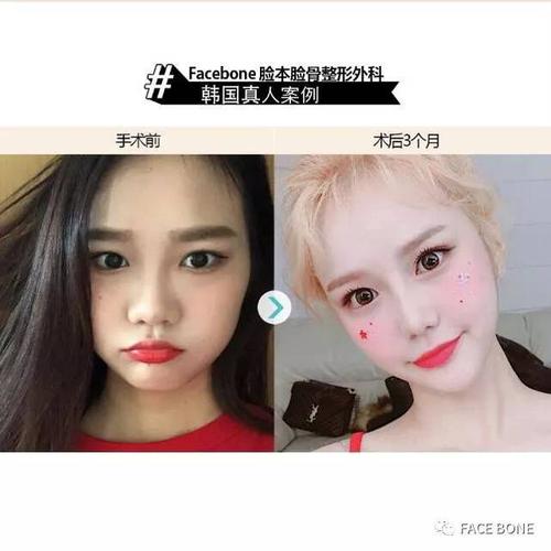 “整容”可不是“make face”_别让老外笑话啦(整容例句可不是)