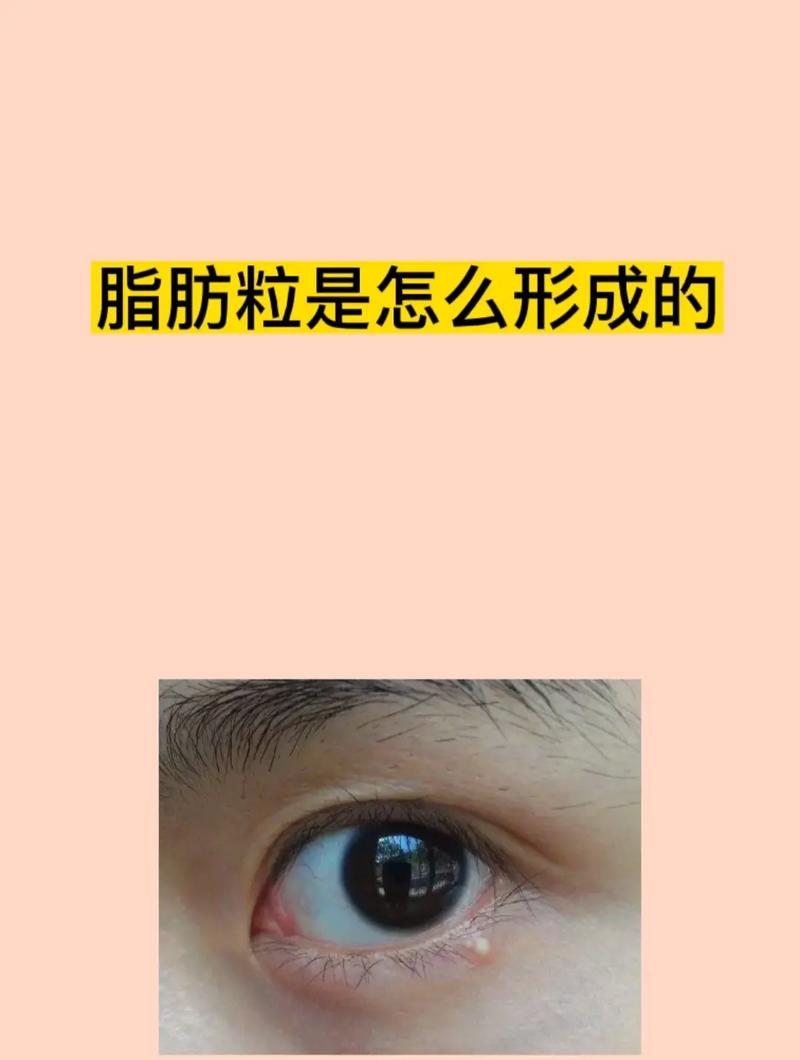 脂肪粒是什么东西？(脂肪粒皮膚眼睛)