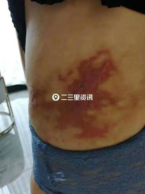 吉林市女子抽脂手术后出现瘢痕维权难_瑞鑫医美：对方体质原因导致(瘢痕女士體質)