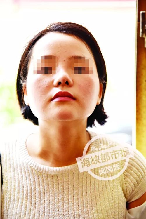 花四万七做鼻综合_青岛女子术后呼吸难、鼻子歪！诊所：还在恢复期(張女士診所鼻子)