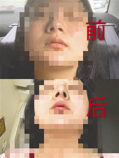 咋回事？在同一美容院整容 多名女子鼻子歪了(消費者手術醫院)