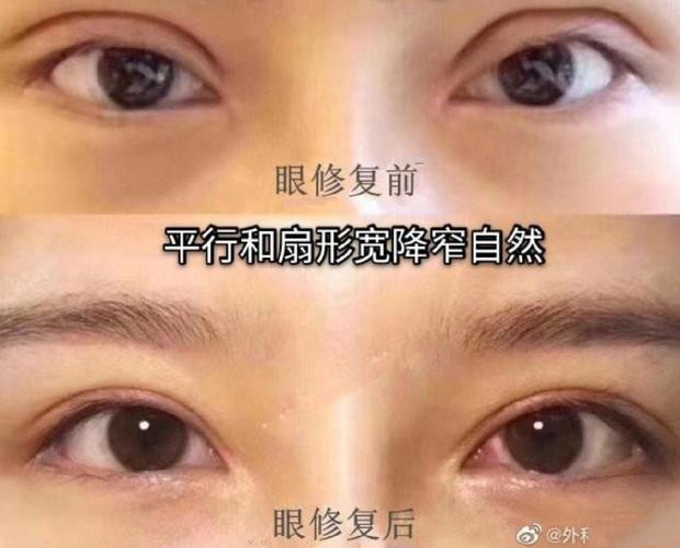 去北京做了双眼皮修复_一次性解决了假、宽、大小眼_漂亮自然！(修復雙眼皮小眼)