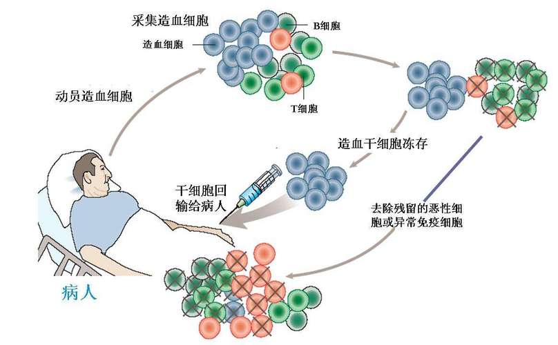 什么是自体造血干细胞移植(移植造血幹細胞患者)