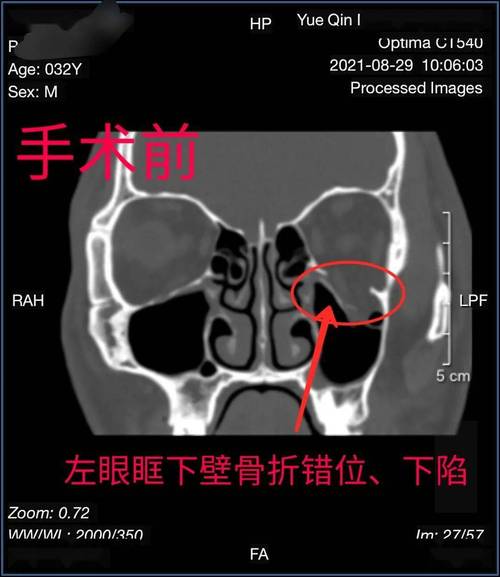 沈北新区医疗集团中心医院眼科联合口腔科独立完成多发颌面骨折整形修复术(骨折眼科患者)