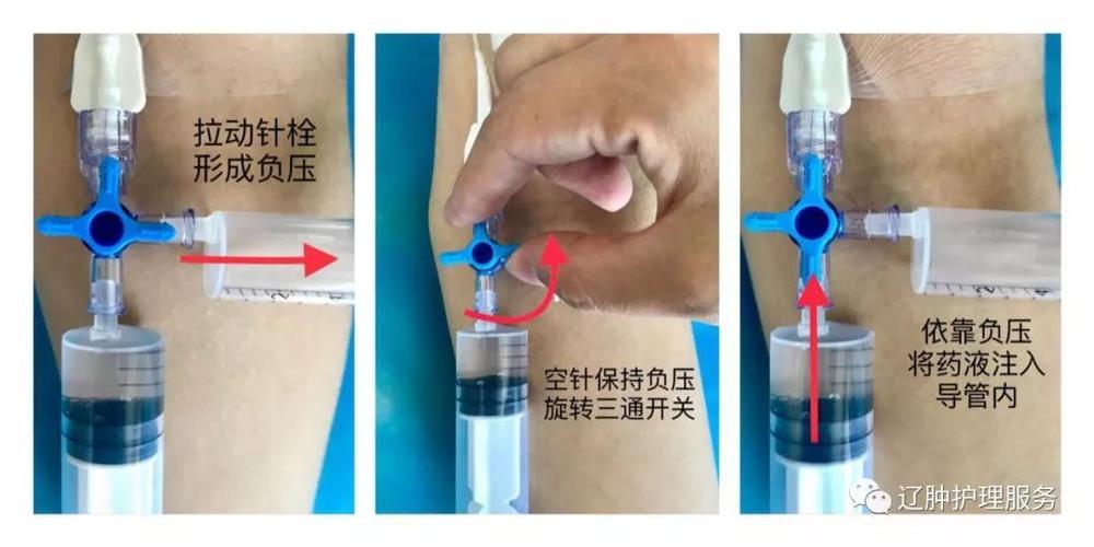 导管怎么只保留了15天？(導管患者堵塞)