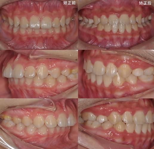 颜值爆灯颌面部整形系列之—神奇的正畸(口腔正畸面部)