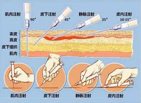 绝对干货：玻尿酸注射面部实战方法~(尿酸註射透明質酸)