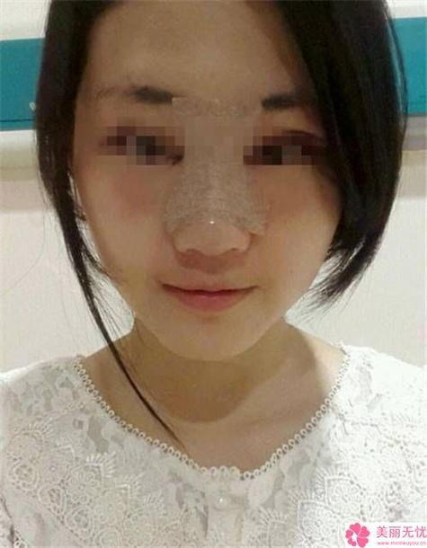 在美容院隆鼻后_她连走路都不敢走快_稍有震动鼻子就疼(女士醫院假體)