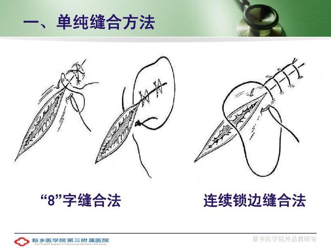 伤口缝合方法五花八门_到底哪种最适合你？(縫合哪種傷口)