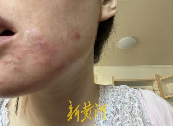 医美祛斑致面部红肿脱皮_如何维权？(醫療美容損害機構)