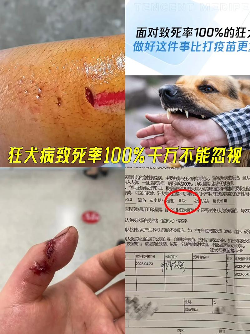 【世界狂犬病日】和“毛孩子”玩耍受伤了_怎么办？(狂犬病疫苗傷口)