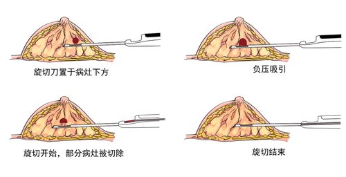 乳腺病灶的活检方式都有哪些呢？(活檢乳腺病灶)