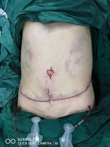 愈发流行的腹壁整形术（Tummy Tuck_Abdominoplasty）(腹壁整形術整形)