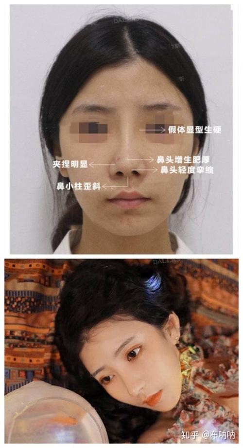 女子想要“网红鼻”_术后却成歪鼻子！期间医生私换假体高度还不告知…(女士鼻子醫生)