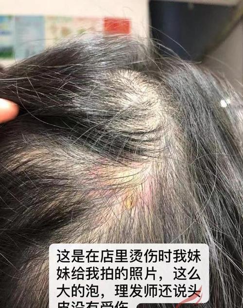 女子烫发时被烫伤索赔三千元_商家：已赔一千五_愿再赔八百(女士燙傷理發店)