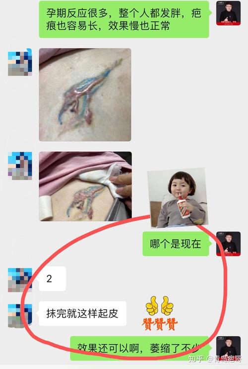 造成你纹身增生的原因到底是什么？一系列的纹身增生科普都在这(紋身增生在這)