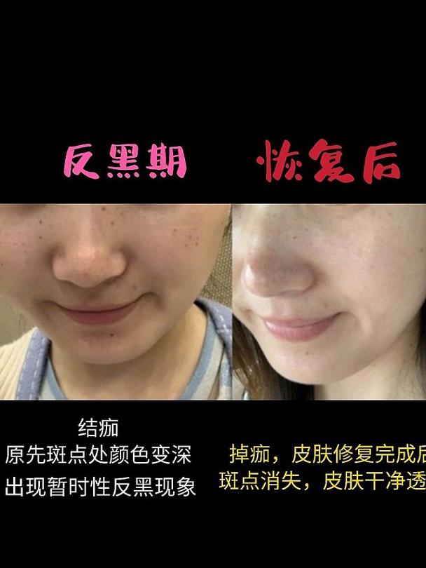 医美治疗的是与非之二——治疗后反黑是怎么回事?(反黑皮膚的是)