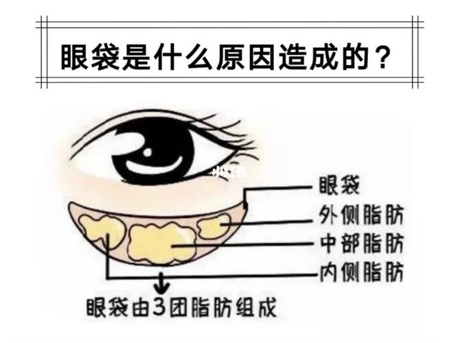 世界美容日丨讨人厌的大眼袋_究竟是如何形成的？(眼袋春雨祛除)