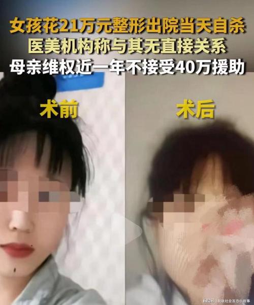 女子隆鼻手术后被送ICU3个月后仍未醒！整形医生称麻醉出问题(整容手術門診)