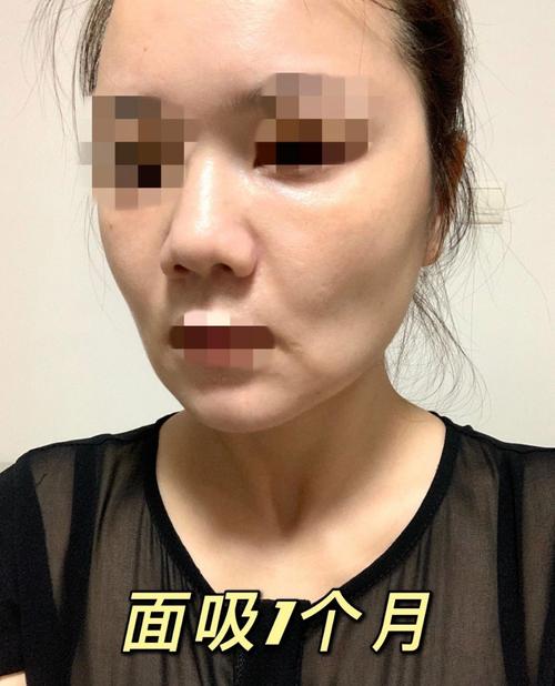 女子注射美容_脸部剧痛感染(王女士註射劇痛)