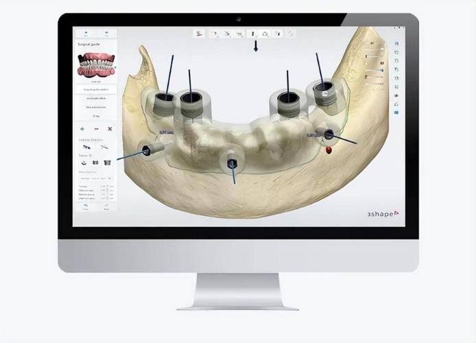 数字化可视种植牙_是否更安心？(種植導板數字化)