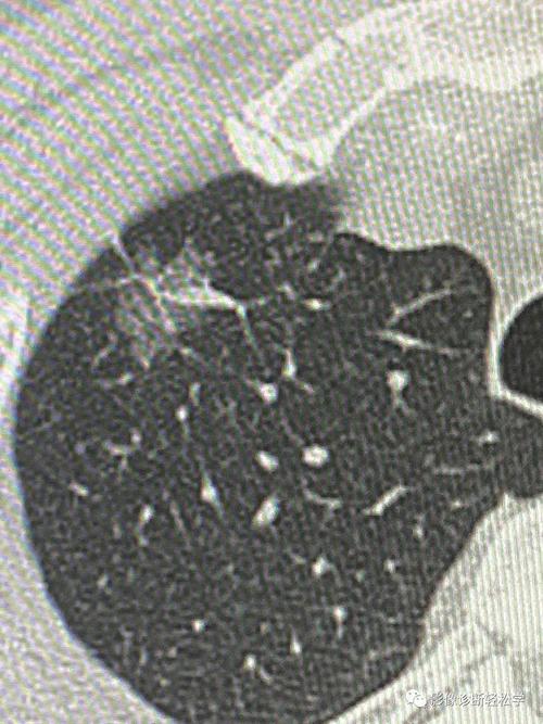 肺癌术前病理中_贴壁型、乳头型、微乳头型_哪种很危险？(乳頭肺癌病理)