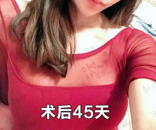 东北女子隆胸后_后悔莫及！一查才发现做手术的是牙医……(美容院女士隆胸)